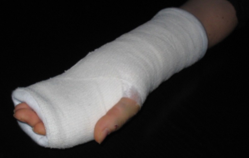 Gipsul va fi înlocuit cu o proteză scoasă la imprimantă 3D 