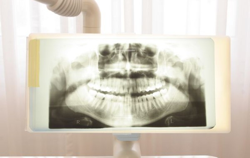 Radiografiile dentare pot provoca apariţia unor tumori pe creier