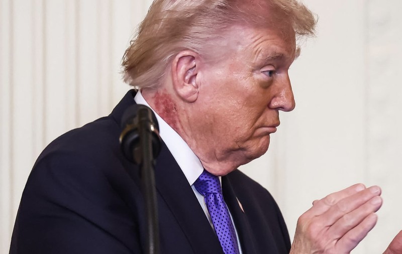 Donald Trump, surprins cu o pată roșie la gât. Cum explică medicul său: „Este așteptată să persiste câteva săptămâni”