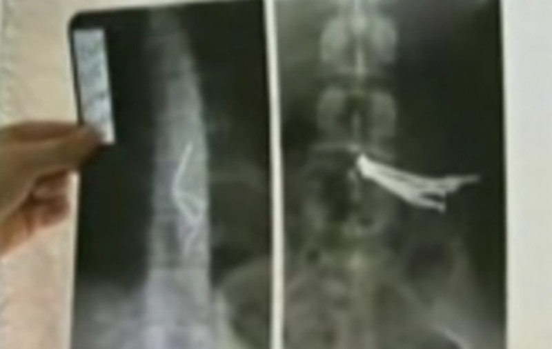 Supărat că a fost părăsit de iubită, a înghiţit un pumn de cuie