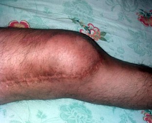 Piciorul avocatului, în diferite etape ale evoluției post-operatorii
