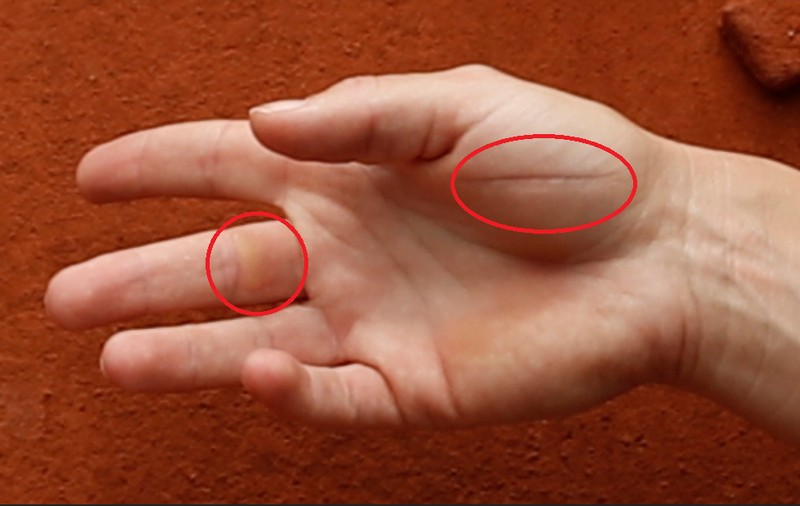 Așa arată palma Simonei Halep, după ce a câștigat primul Mare Șlem. Gloria cere sacrificii