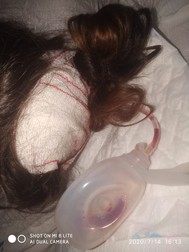 Medicii au trebuit să intervină pentru a reconstrui vena
