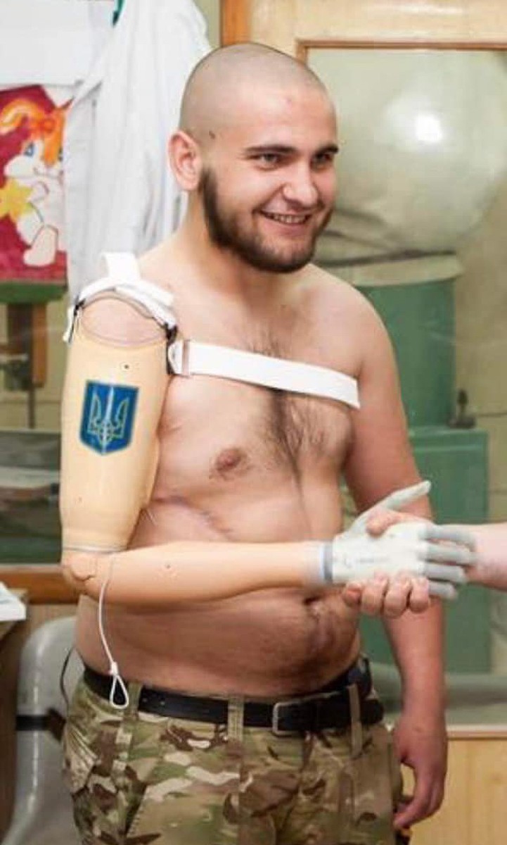 Vasil Peleș cu proteza bionică