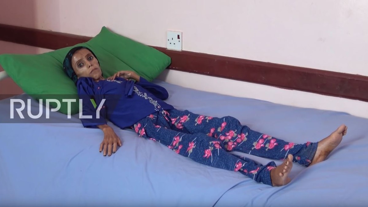 O fetiță din Yemen cântărește 10 kilograme, la 12 ani,