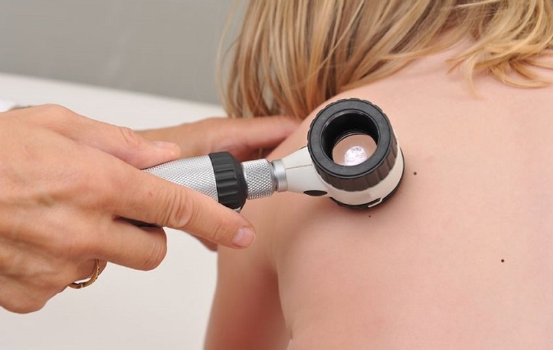 Cancerul de piele: ce e carcinomul și cum îl recunoști