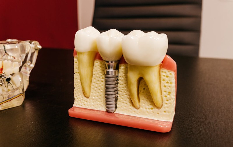 5 avantaje ale implantului dentar