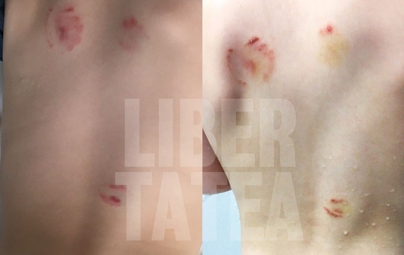 EXCLUSIV / Copil de 1 an și 8 luni, mușcat violent la grădiniță. Copilul a rămas cu traume