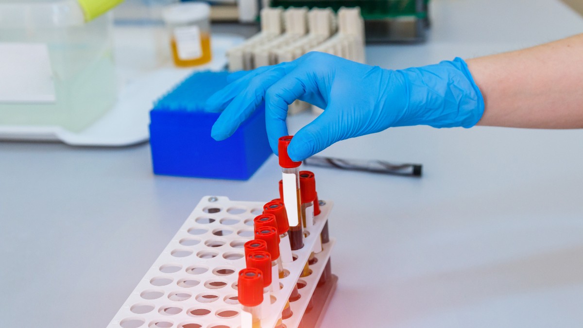 Imaginea surprinde o mână care poartă o mănușă chirurgicală albastră și așază un tub de sânge cu dop roșu într-un stativ din plastic, într-un laborator medical. Tuburile de sânge sunt aliniate în stativ, iar în fundal se observă alte echipamente de laborator.