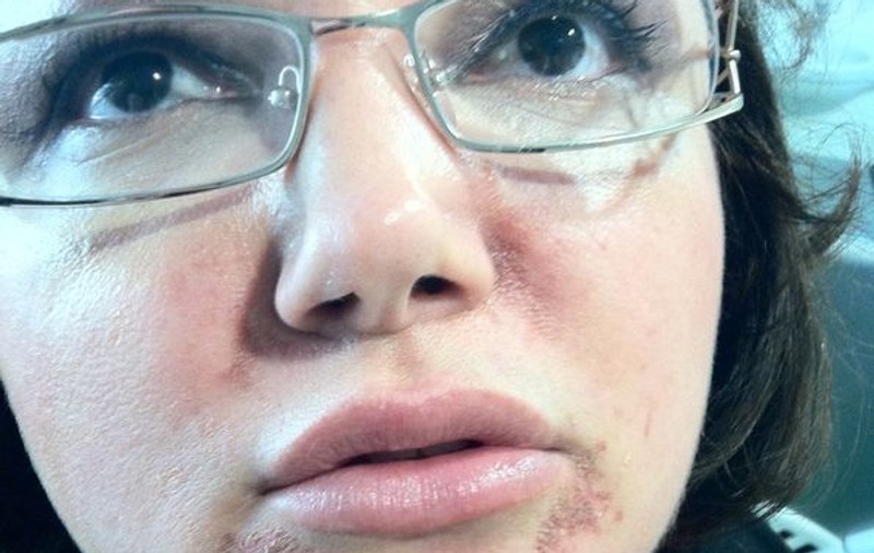 Ozana Barabancea, cu faţa distrusă de un tratament de hidratare a pielii: ”Mi-e groază să mă uit in oglindă”