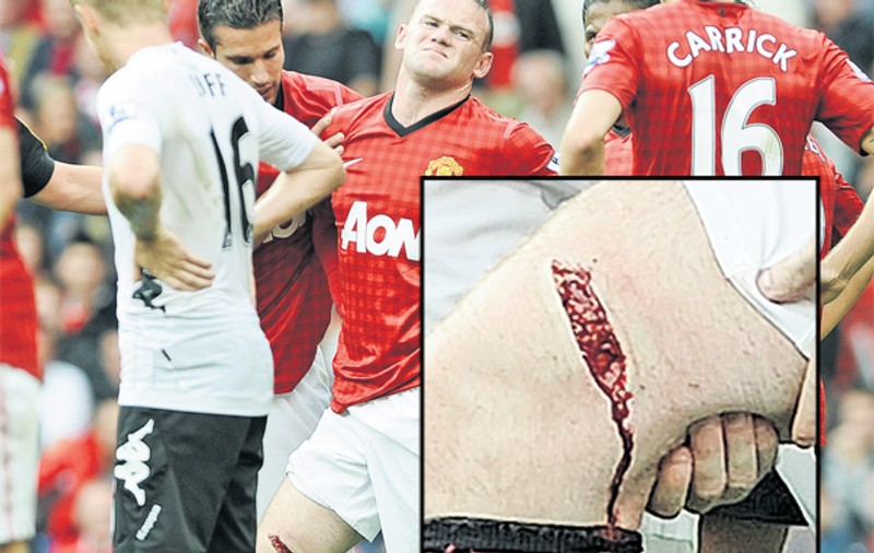 Wayne Rooney, atacantul lui Manchester United, a suferit o accidentare oribilă şi va lipsi o lună