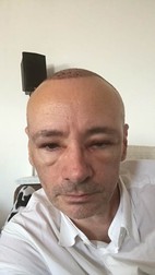 Imagine horror cu Mihai Albu după ce și-a făcut implant de păr