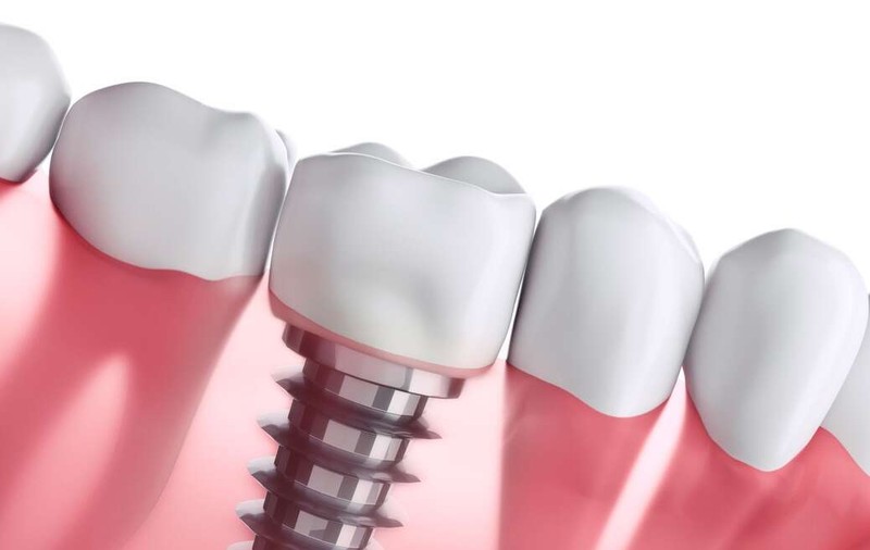 Restaurarea Zâmbetului Perfect cu Implanturile Dentare de la Stomestet Cluj