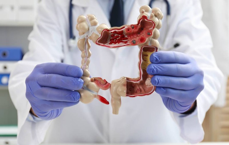 Alimentul accesibil care reduce riscul de cancer de colon. Expert: „Consumat regulat, are un efect protector”