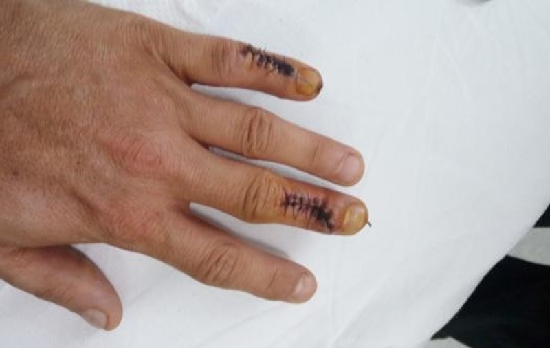 Un tânăr din Cluj, operat la degetul care nu trebuie. Doctorul a aflat în timpul operației că nu intervine unde trebuie