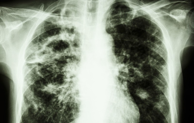Statistică îngrijorătoare: Suntem țara membră a Uniunii Europene cu cele mai multe cazuri noi de tuberculoză înregistrate