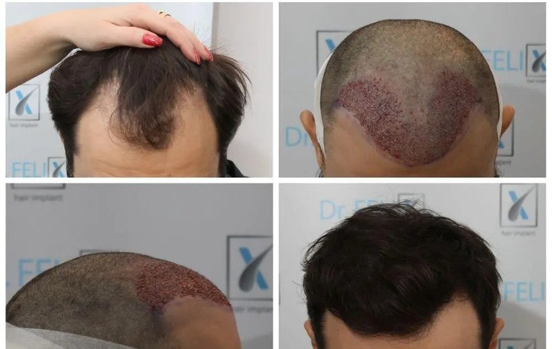 Cum te afectează lipsa podoabei capilare? Află despre o clinică specializată în implant de păr